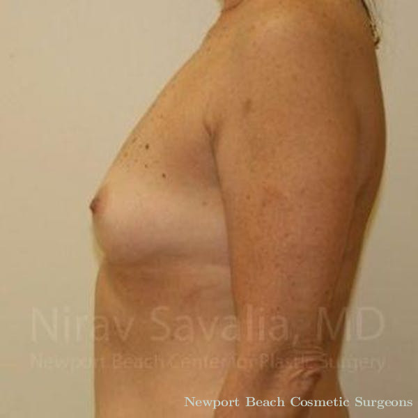 Breast Explantation En Bloc Capsulectomy Before & After Gallery - Patient 1655519 - Before