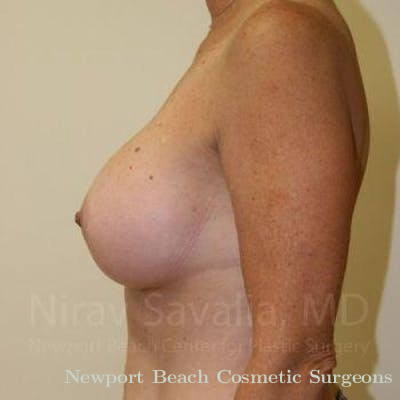 Chin Implants Before & After Gallery - Patient 1655519 - After