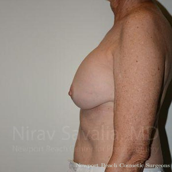 Mastectomy Reconstruction Before & After Gallery - Patient 1655520 - Before