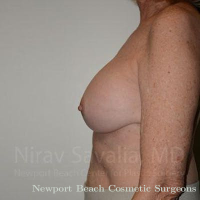 Oncoplastic Reconstruction Before & After Gallery - Patient 1655520 - After