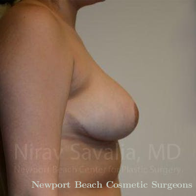 Breast Explantation En Bloc Capsulectomy Before & After Gallery - Patient 1655522 - After