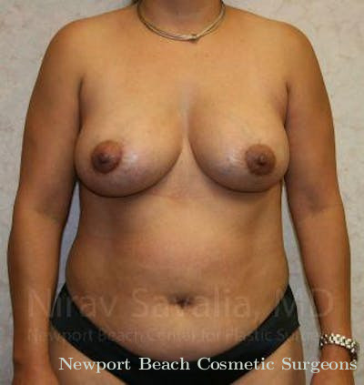 Liposuction Before & After Gallery - Patient 1655529 - After