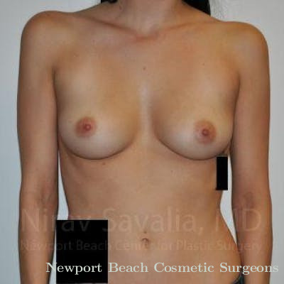 Breast Explantation En Bloc Capsulectomy Before & After Gallery - Patient 1655528 - Before