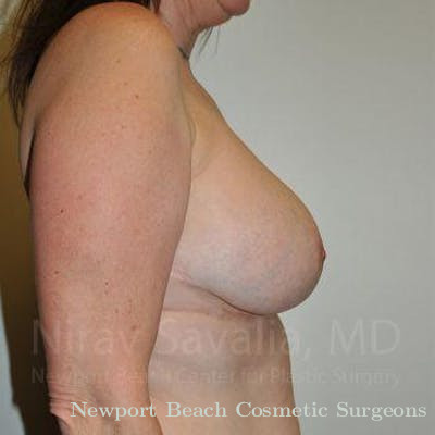 Breast Explantation En Bloc Capsulectomy Before & After Gallery - Patient 1655526 - After