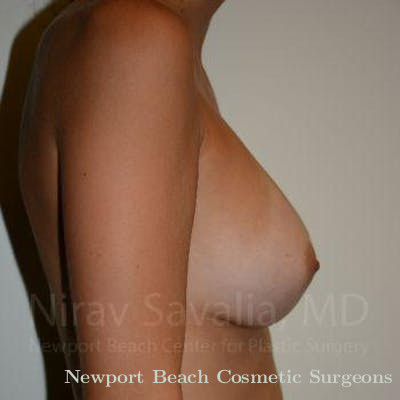 Mastectomy Reconstruction Before & After Gallery - Patient 1655528 - After