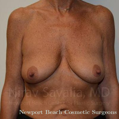 Mastectomy Reconstruction Revision Before & After Gallery - Patient 1655532 - Before
