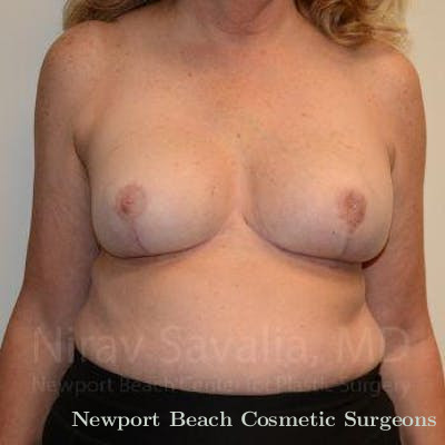 Breast Implant Revision Before & After Gallery - Patient 1655533 - After