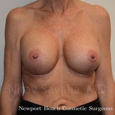 Mastectomy Reconstruction Revision Before & After Gallery - Patient 1655532 - After
