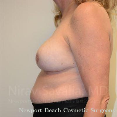 Male Breast Reduction Before & After Gallery - Patient 1655533 - After