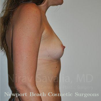 Breast Lift without Implants Before & After Gallery - Patient 1655531 - Before
