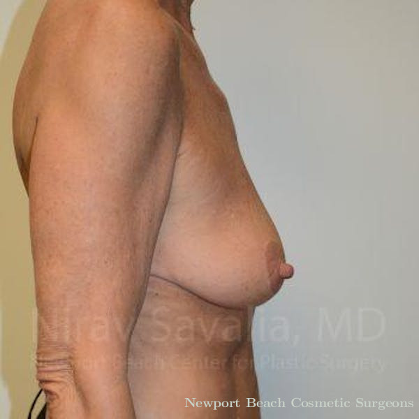 Breast Lift with Implants Before & After Gallery - Patient 1655532 - Before