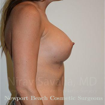 Chin Implants Before & After Gallery - Patient 1655531 - After