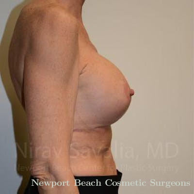 Facelift Before & After Gallery - Patient 1655532 - After