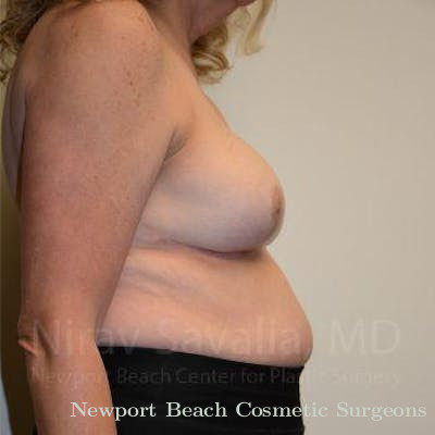 Breast Explantation En Bloc Capsulectomy Before & After Gallery - Patient 1655533 - After