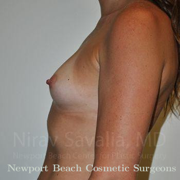 Breast Augmentation Before & After Gallery - Patient 1655531 - Before