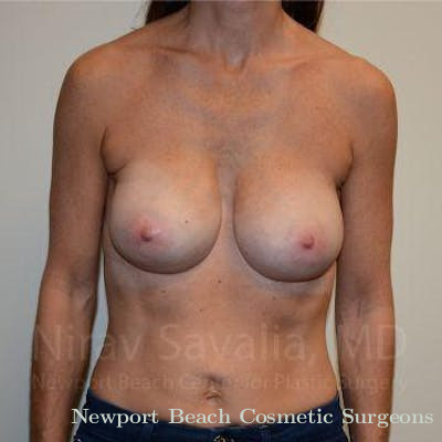 Breast Lift with Implants Before & After Gallery - Patient 1655536 - After