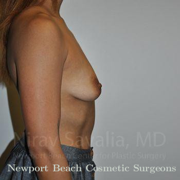 Mastectomy Reconstruction Before & After Gallery - Patient 1655537 - Before
