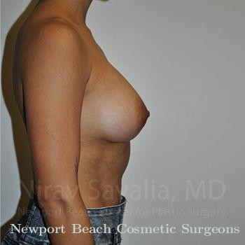 Breast Augmentation Before & After Gallery - Patient 1655537 - After