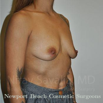 Breast Explantation En Bloc Capsulectomy Before & After Gallery - Patient 1655537 - Before