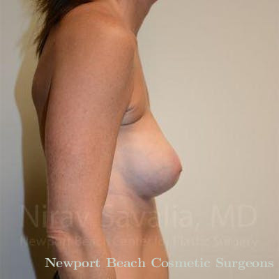 Breast Explantation En Bloc Capsulectomy Before & After Gallery - Patient 1655536 - After
