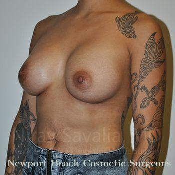 Breast Explantation En Bloc Capsulectomy Before & After Gallery - Patient 1655537 - After