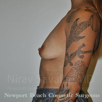 Breast Lift without Implants Before & After Gallery - Patient 1655537 - Before