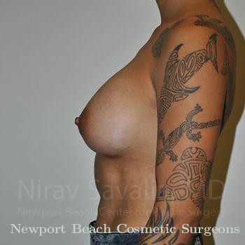 Breast Lift with Implants Before & After Gallery - Patient 1655537 - After