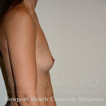 Breast Lift with Implants Before & After Gallery - Patient 1655540 - Before