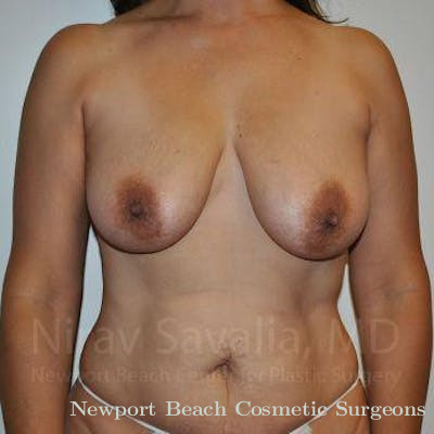 Mastectomy Reconstruction Revision Before & After Gallery - Patient 1655542 - Before