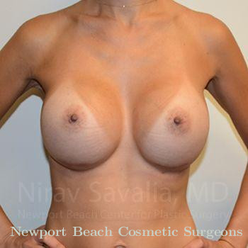 Mastectomy Reconstruction Before & After Gallery - Patient 1655540 - After