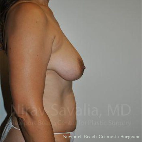 Breast Lift with Implants Before & After Gallery - Patient 1655542 - Before