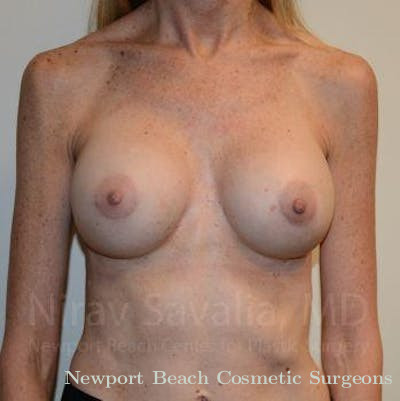 Fat Grafting to Face Before & After Gallery - Patient 1655543 - After