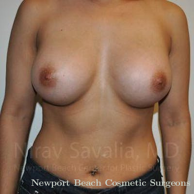Chin Implants Before & After Gallery - Patient 1655544 - After