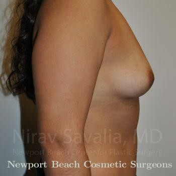 Breast Implant Revision Before & After Gallery - Patient 1655544 - Before