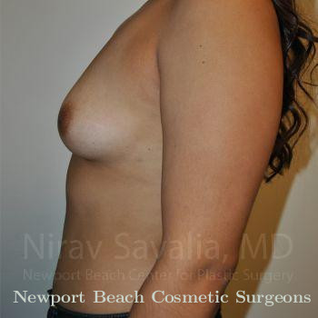 Breast Augmentation Before & After Gallery - Patient 1655544 - Before