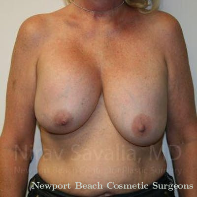 Breast Lift with Implants Before & After Gallery - Patient 1655545 - Before