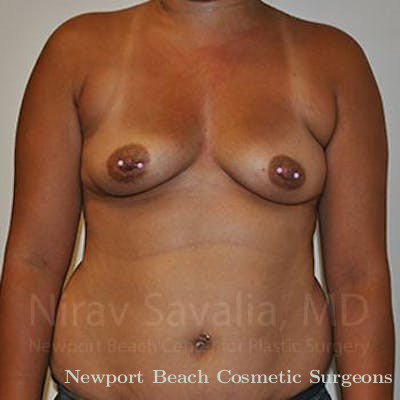 Breast Augmentation Before & After Gallery - Patient 1655546 - Before