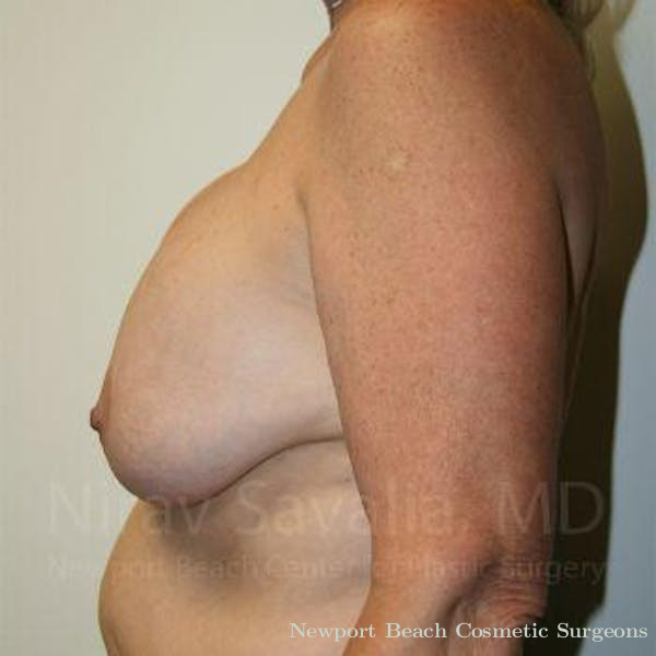 Breast Implant Revision Before & After Gallery - Patient 1655545 - Before