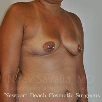 Breast Implant Revision Before & After Gallery - Patient 1655546 - Before