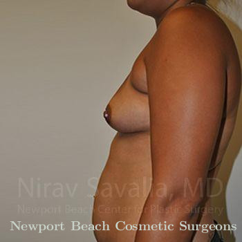 Breast Reduction Before & After Gallery - Patient 1655546 - Before