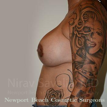 Breast Reduction Before & After Gallery - Patient 1655546 - After