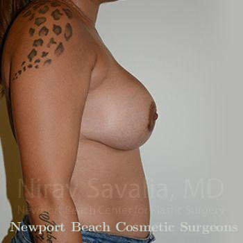 Body Contouring after Weight Loss Before & After Gallery - Patient 1655546 - After