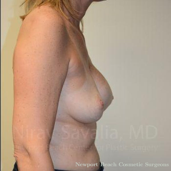 Breast Implant Revision Before & After Gallery - Patient 1655547 - Before