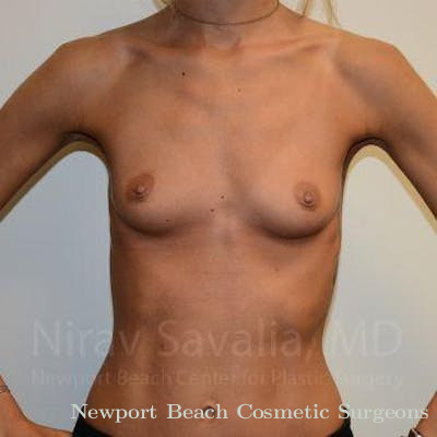 Breast Augmentation Before & After Gallery - Patient 1655548 - Before