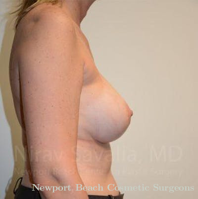 Mastectomy Reconstruction Revision Before & After Gallery - Patient 1655547 - After