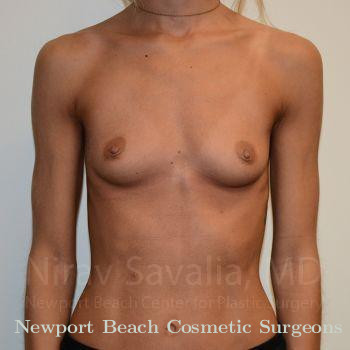 Breast Implant Revision Before & After Gallery - Patient 1655548 - Before