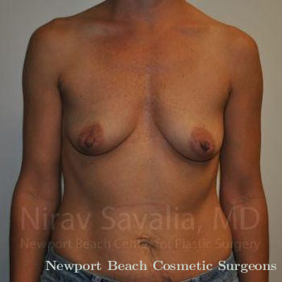 Mastectomy Reconstruction Revision Before & After Gallery - Patient 1655550 - Before