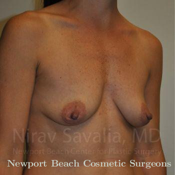 Breast Explantation En Bloc Capsulectomy Before & After Gallery - Patient 1655550 - Before