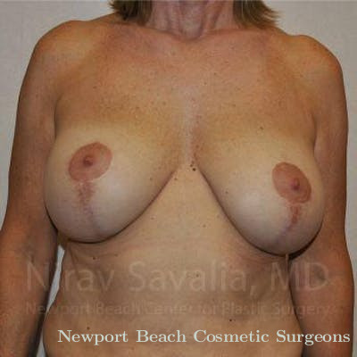 Mastectomy Reconstruction Before & After Gallery - Patient 1655552 - Before