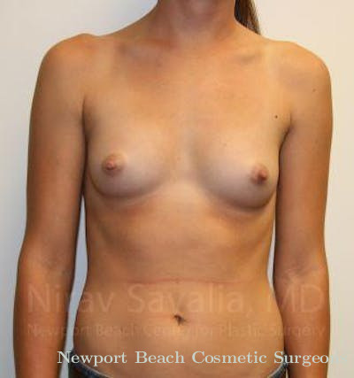 Breast Augmentation Before & After Gallery - Patient 1655551 - Before